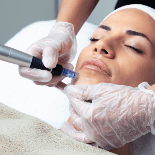  Experience the Magic of Microneedling